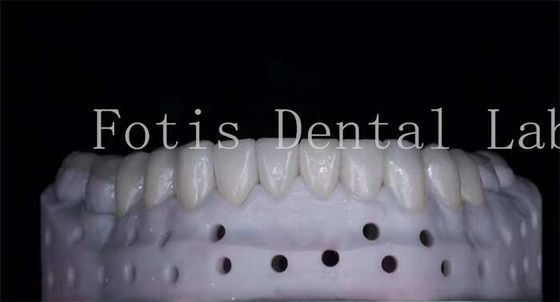 OEM ODM ทนทานคราบ สภาพธรรมชาติ โปรเซลีน veneers ความแข็งแรงสูง