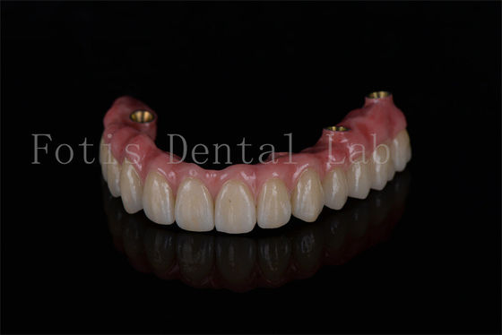 การฟื้นฟูกระดูกฟันครบครัน All On Four Implants เพื่อให้การผลิตของกระดูกฟันได้ดีที่สุด