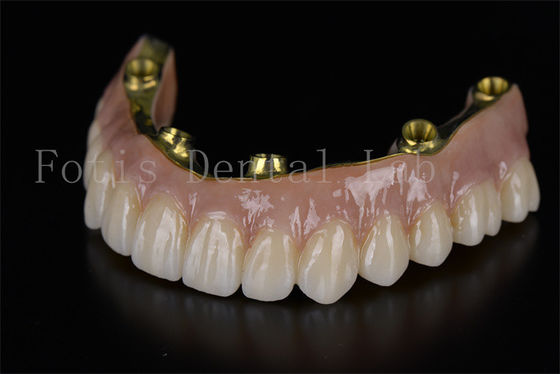 ซื้อ การฟื้นฟูคลุมเต็ม All On Six Implants การแก้ไขที่รุนแรงน้อย online manufacture