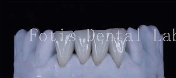 ฟันผงซินเทติกละมุน หนา 0.3-0.5 มม สวยงาม
