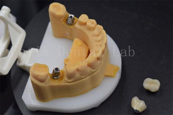 ง่ายที่จะวาง Zirconia รางวัลฟัน รางวัลไทเทเนียมสําหรับฟัน