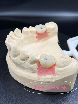 การปรับแต่ง ทิตานี / ซิโคเนีย / PFM รางวัลห้องปฏิบัติการฟัน สบาย