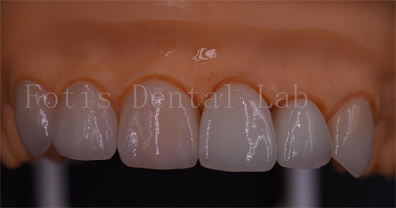 3 Shape Digital Crowns ความเข้ากันได้ดี Dentrues ออกแบบ 1 วัน ส่ง