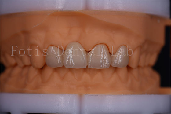 FDA ยืนยัน Digital Crowns Bridge Dentrues การออกแบบขนาดที่สามารถปรับแต่งได้