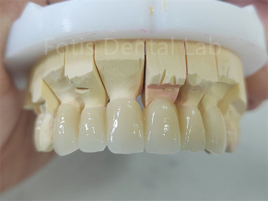 ผลิตภัณฑ์ฟัน Zirconia แผ่นผิวเคลือบด้วย Porcelain การบํารุงรักษาง่าย