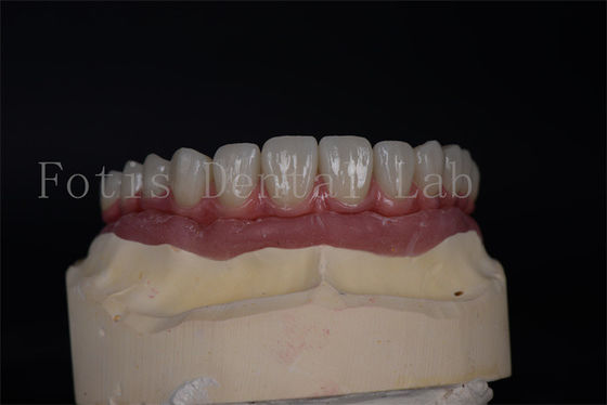 อีสเตติกธรรมชาติ ด้วยอัตราการจ่ายที่คุ้ม All on 4 All on 6 Implants